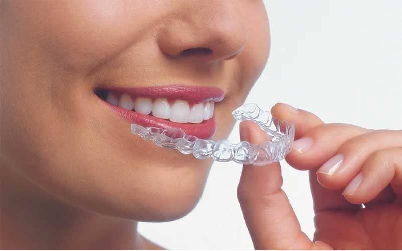 Clear aligners for invisible teeth straightening