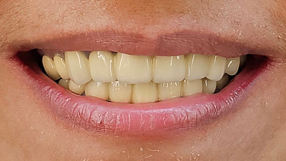 Cosmetic Dentistry at Smile Masterz Dental Clinic, Borivali, Mumbai (1 of 2)