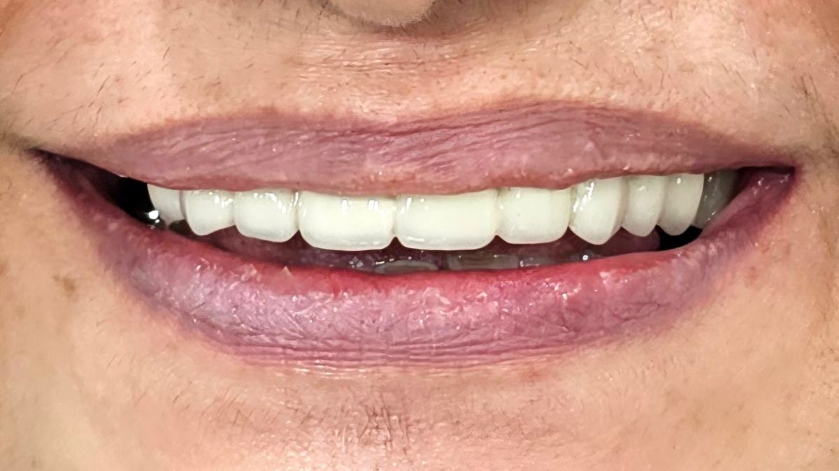 Cosmetic Dentistry at Smile Masterz Dental Clinic, Borivali, Mumbai (2 of 2)