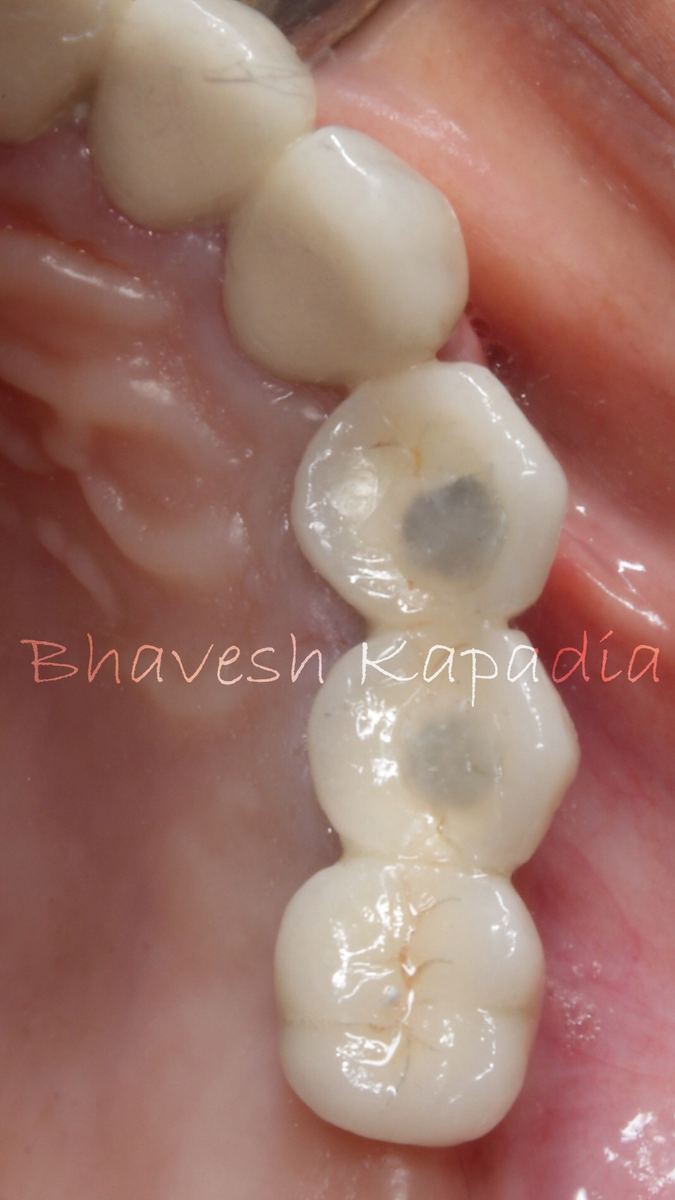 Dental Implants at Smile Masterz Dental Clinic, Borivali, Mumbai (2 of 2)