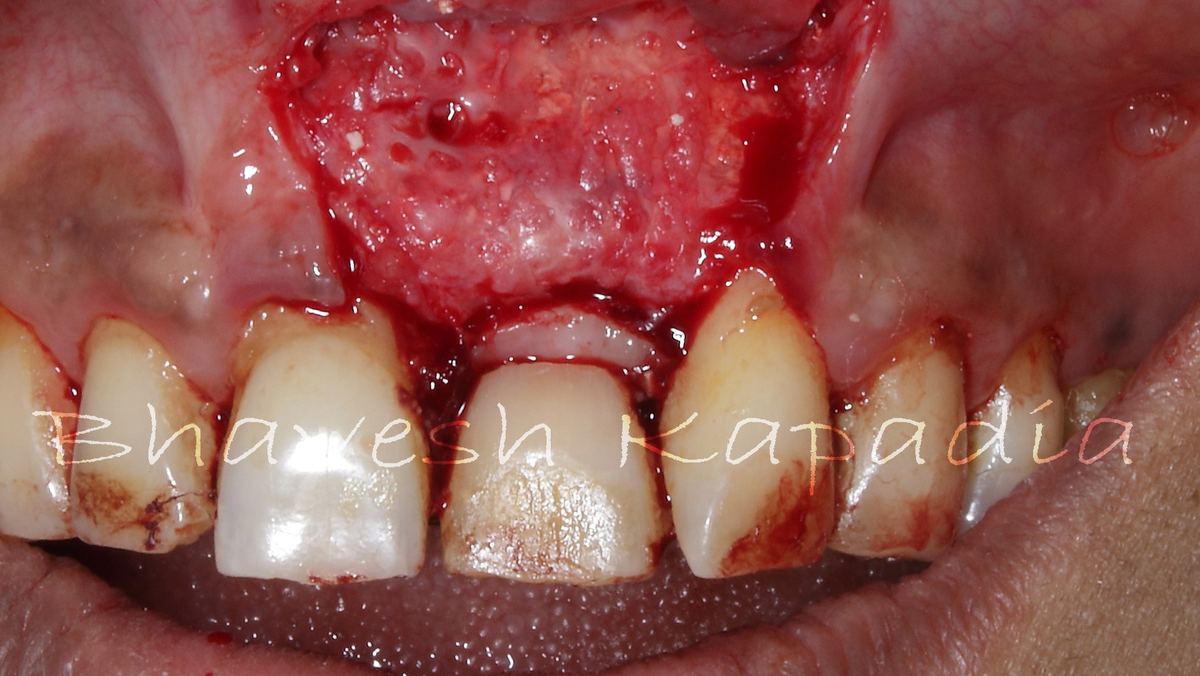 Oral Surgery at Smile Masterz Dental Clinic, Borivali, Mumbai (2 of 2)