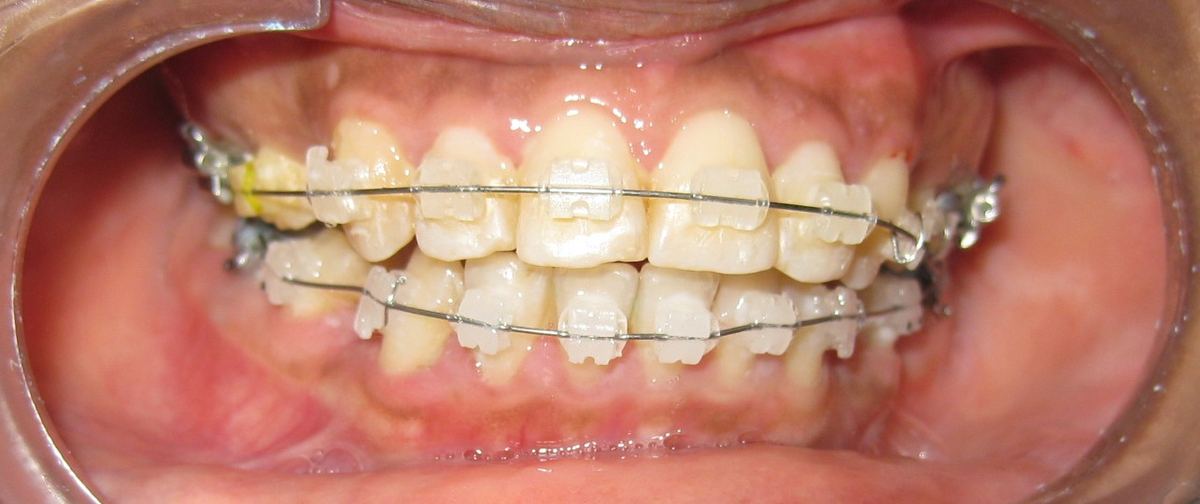 Orthodontics at Smile Masterz Dental Clinic, Borivali, Mumbai (1 of 2)