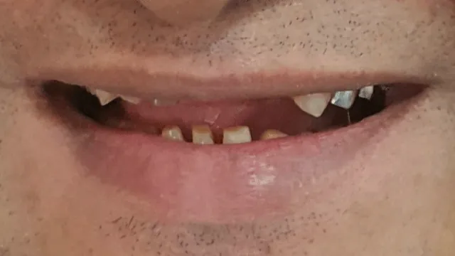 Before and after: dental treatment result