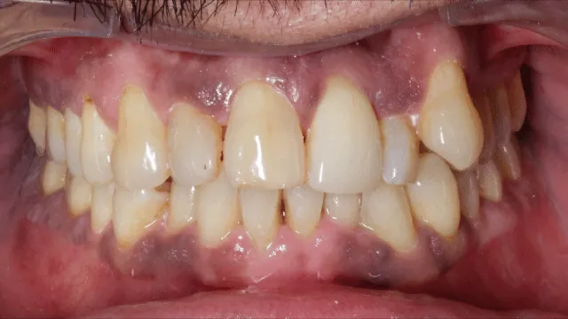 Before and after: teeth alignment progress