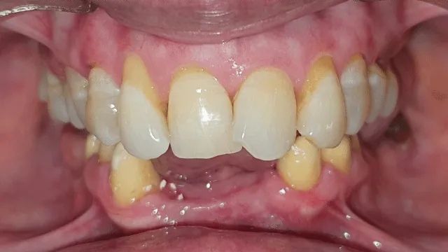 Before and after: orthodontic treatment result