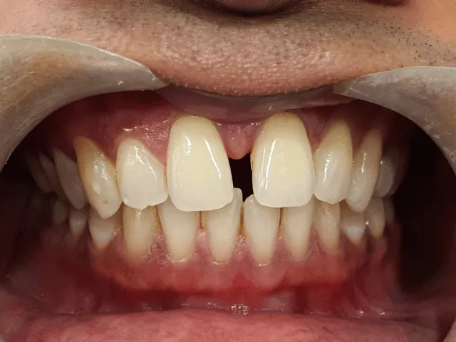 Before and after: gap between front teeth closed