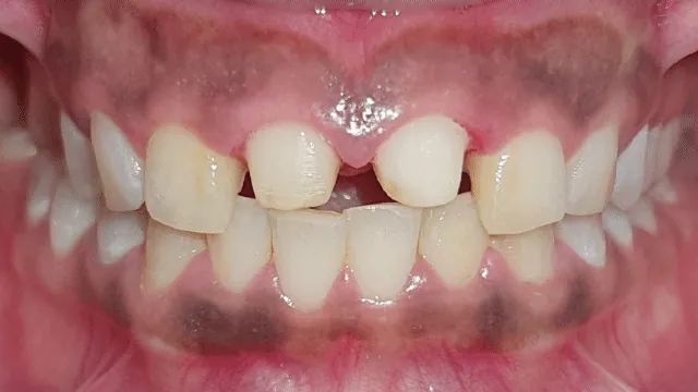 Before and after: dental alignment journey