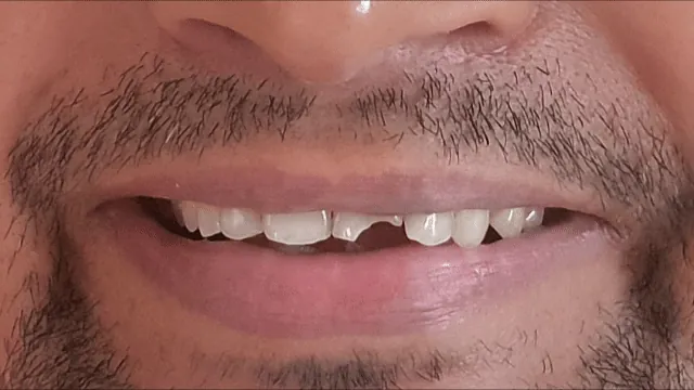 Before and after: smile enhancement