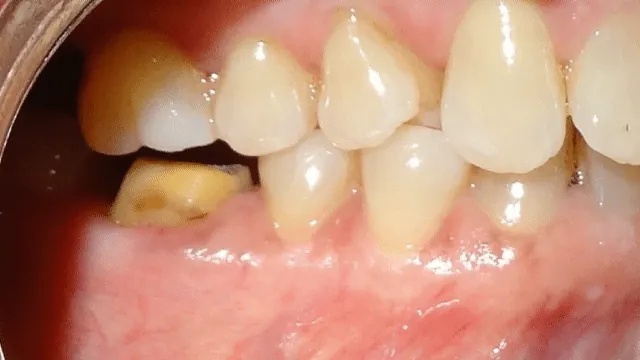Before and after: side view of teeth improvement