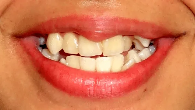 Before and after: braces treatment progress