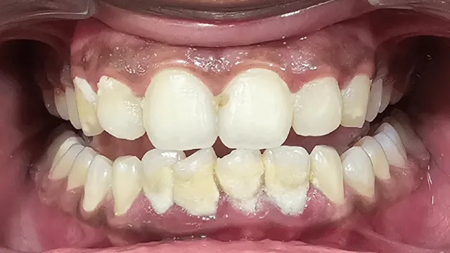 Before and after: teeth straightening result