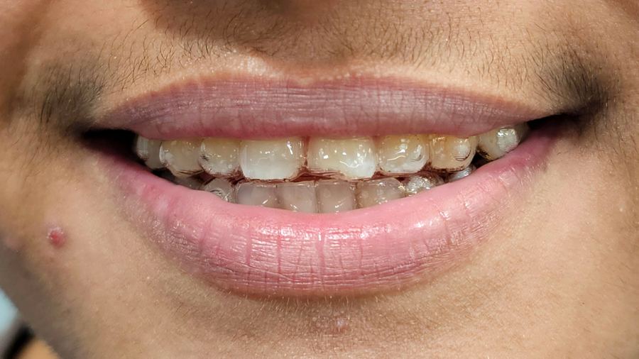 Smile during invisible braces treatment