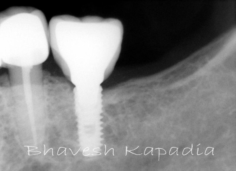 X-ray of a dental implant with crown