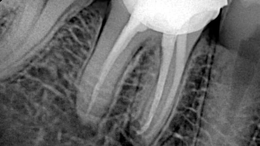 X-ray of a root canal treated molar