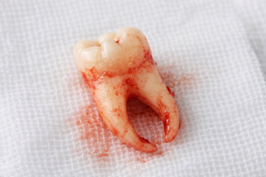 Extracted molar tooth