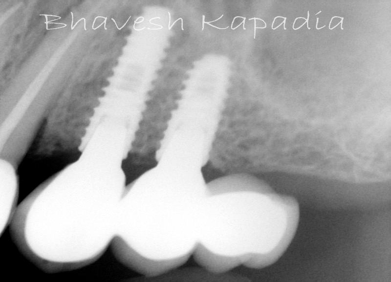 X-ray of two dental implants with crowns