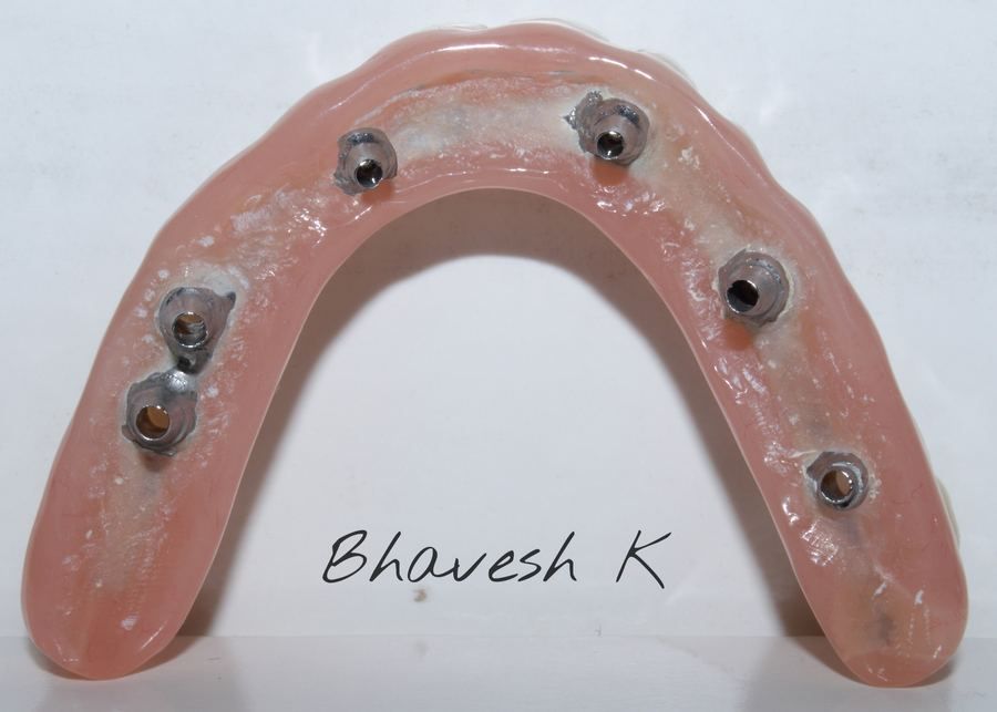 Full-arch implant-supported denture framework
