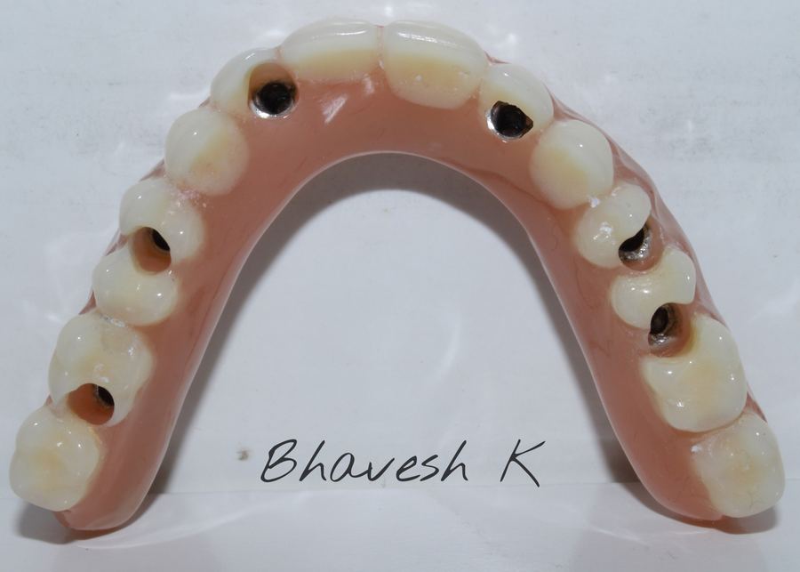 Full-arch implant-supported prosthesis with teeth