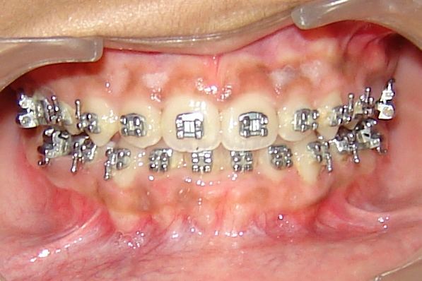 Orthodontics at Smile Masterz Dental Clinic, Borivali, Mumbai (2 of 2)