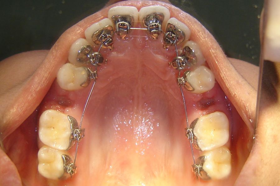 Lingual braces fitted behind the upper teeth