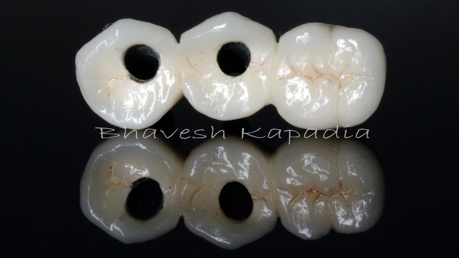 Ceramic dental crowns made for a patient