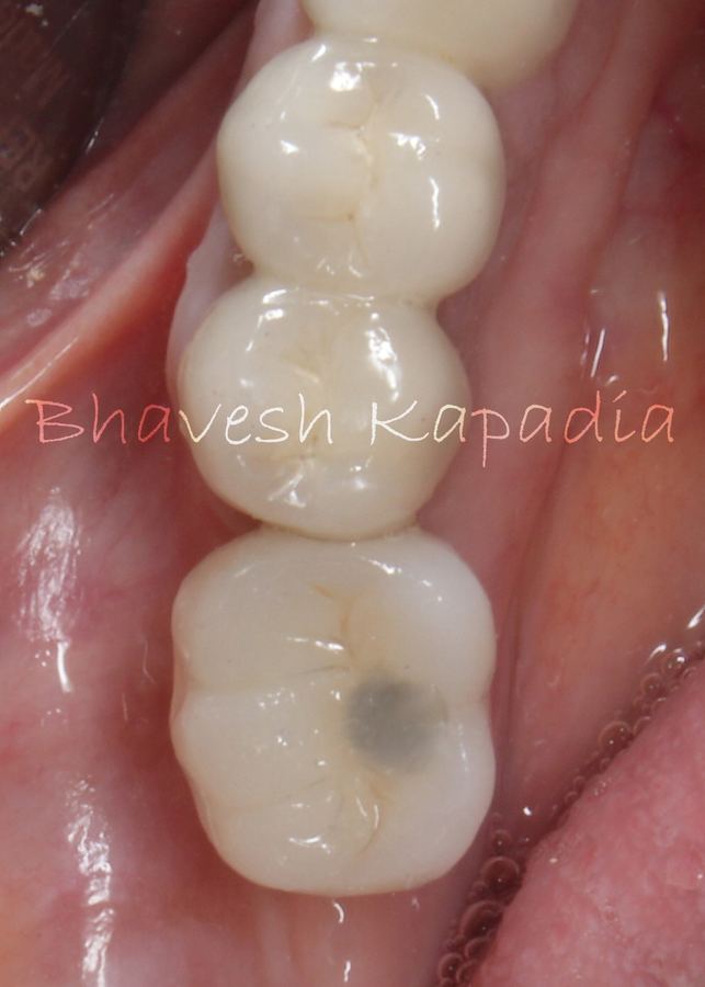 Dental implant crown restored on a molar