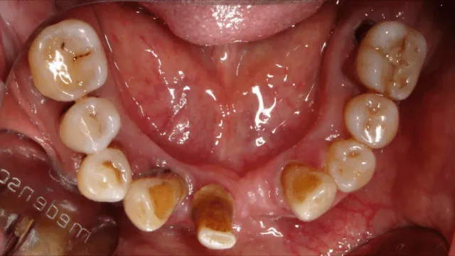 Before and after: lower teeth dental treatment