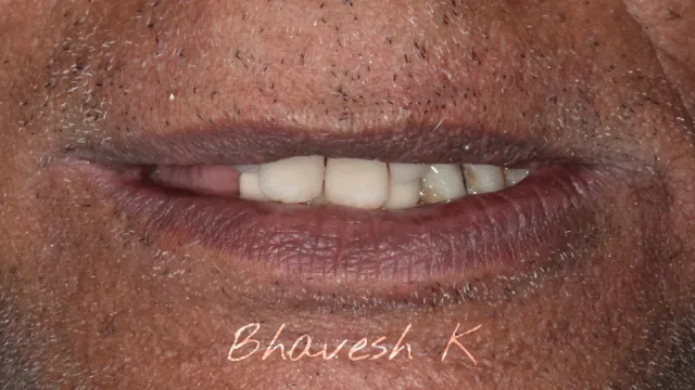 Before and after: smile transformation